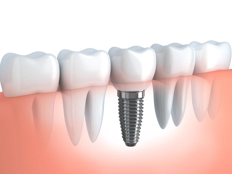 Dental Implants Hutchinson, KS 
