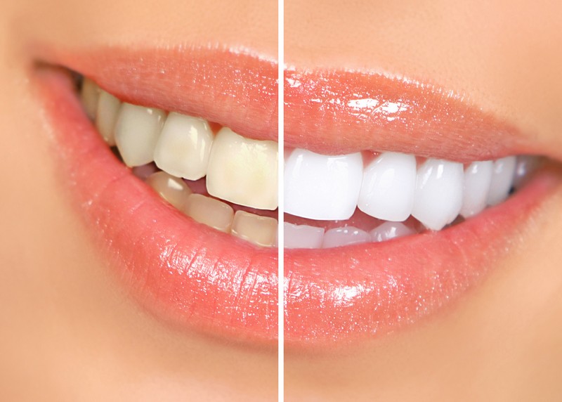 Teeth Whitening Hutchinson, KS 